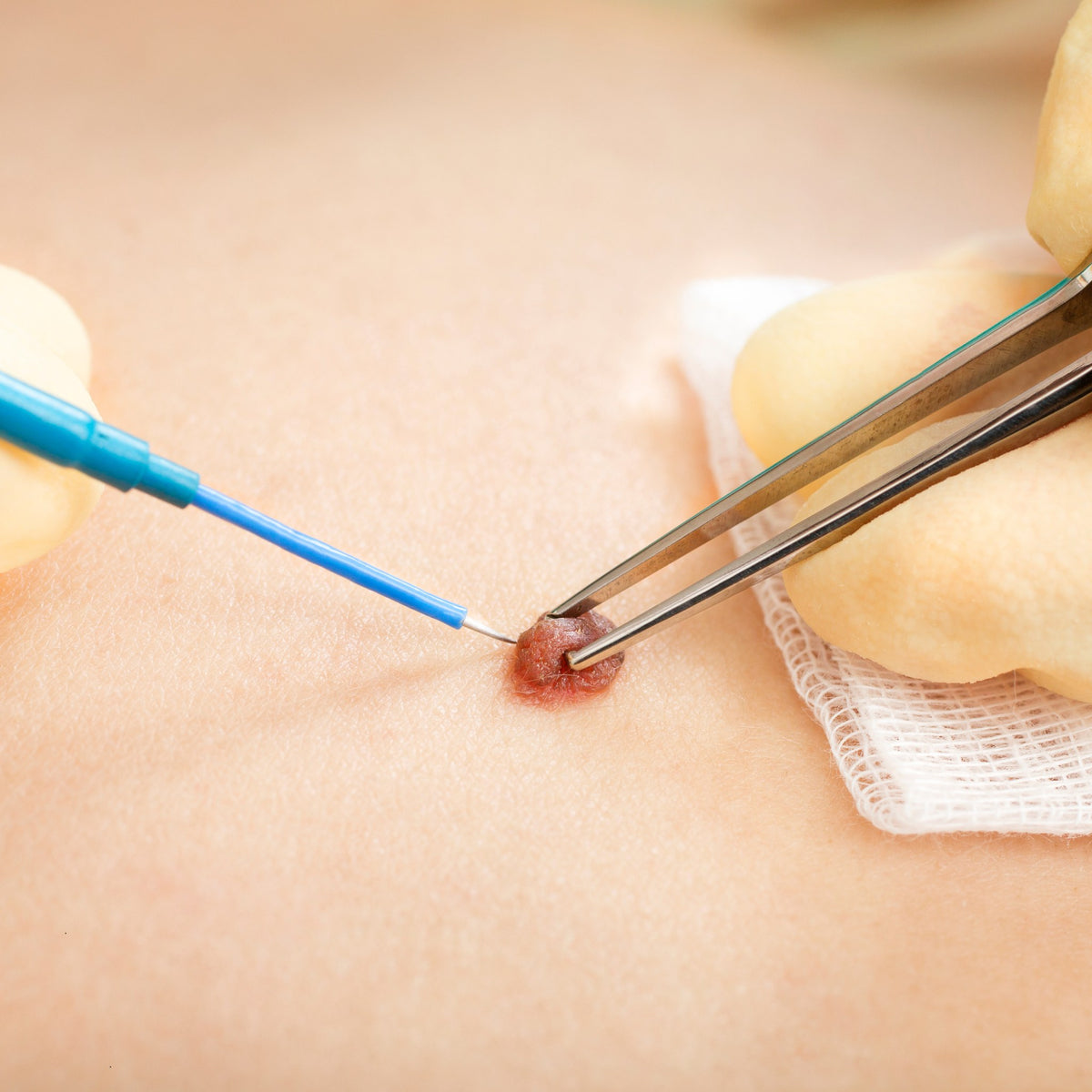 Diathermy probe removing a skin tag - SHBBSKS007 diathermy training